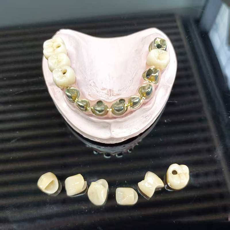 Full-Arch Metal-Ceramic Bridge (PFM Full Arch Prosthesis)